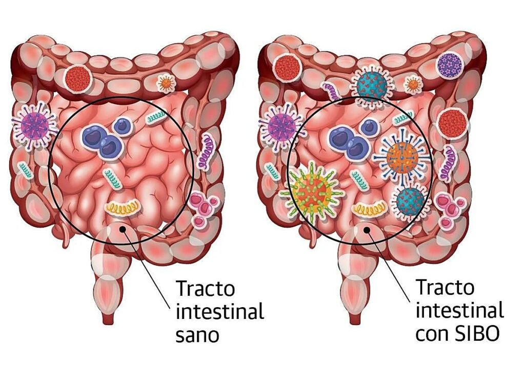 sobrecrecimiento bacteriano en el intestino delgado (SIBO)